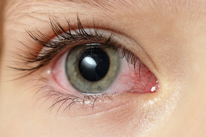 Modafinil for Conjunctivitis and Mouth Ulcers