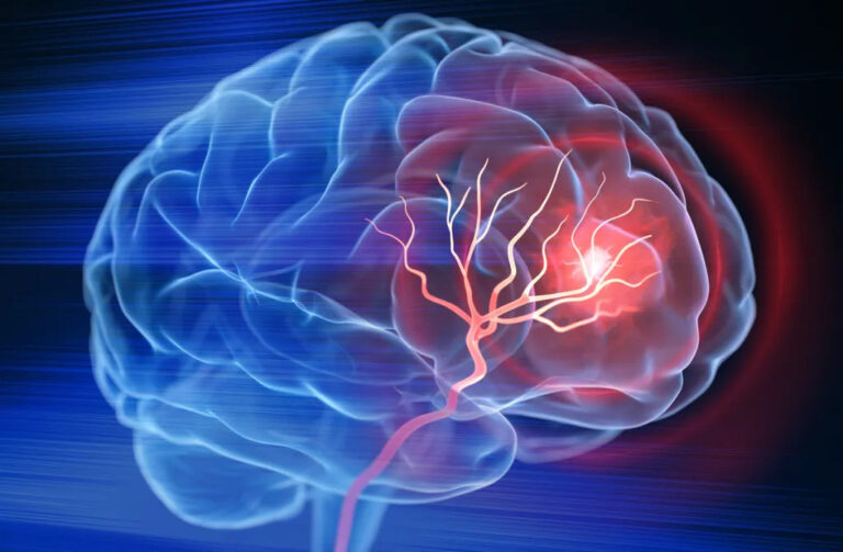 Modafinil and Brain Stroke